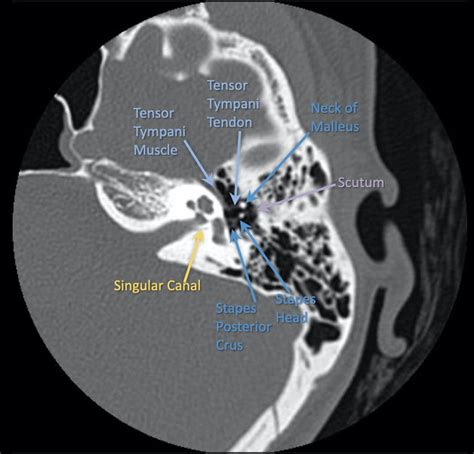 Temporal bone | Radiology Reference Article | Radiopaedia.org