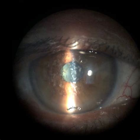 Granular corneal dystrophy - American Academy of Ophthalmology