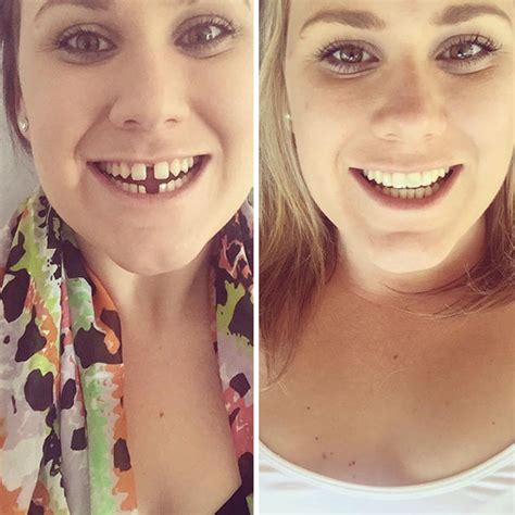 10+ Incredible Before & After Transformations Of People Who Wore Braces ...