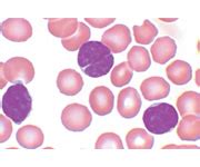 Follicular Lymphoma (FL) | Flow Cytometry