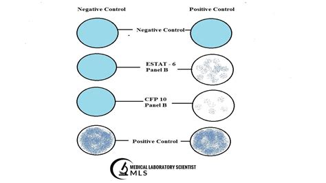 T-Spot Test Procedure | Lab Tests Guide