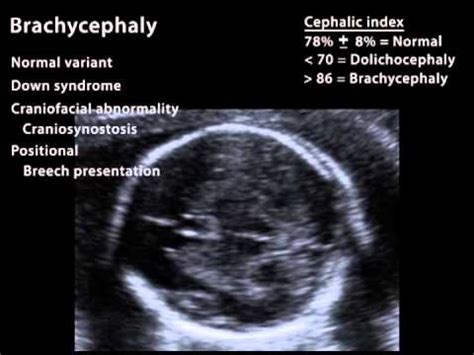 Fetal Biometery - YouTube