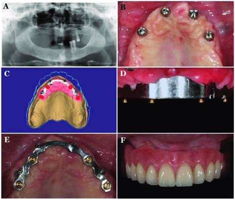 CAD/CAM titanium-bar-supported maxillary overdenture Pretreatment... | Download Scientific Diagram