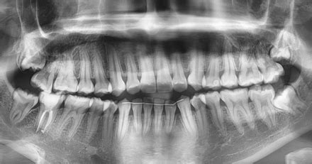 Complications Associated with Wisdom teeth pain | Dr. Nechupadam Dental ...