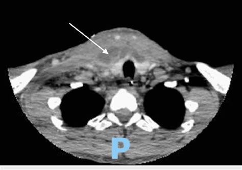 Axial view of CT scan on hospital day 5 Axial view of CT scan on ...