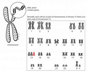 Trisomy 13 – Ohio Fetal Medicine Collaborative