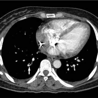 CT pulmonary angiogram on the third day of hospital admission shows a... | Download Scientific ...