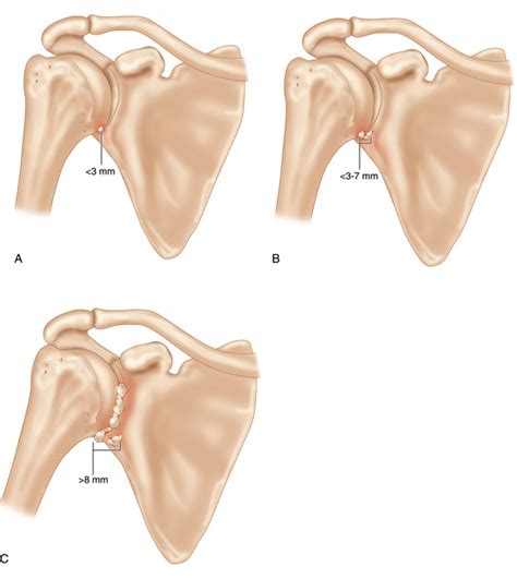 Glenohumeral stiffness and arthritis after instability surgery—causes and treatment ...