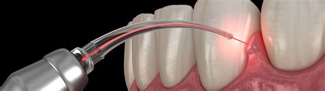 Gingivectomy & Gingivoplasty | Orange, CA | Dr Christopher J Fotinos