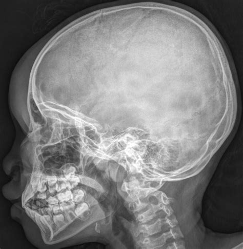 X Ray Cranium Indications soft Tissue Sweling - Radiology Imaging