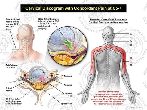 Male Left Cervical Discogram with Concordant Pain at C5-7