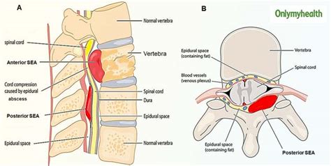 Spinal Infections, A Rare Yet Significant Cause Of Spinal Deformities ...