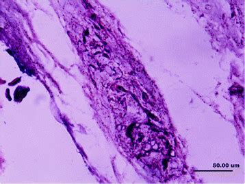 A longitudinal section of a Golgi tendon organ (type III ...