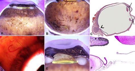 Enucleated eye: pathology findings. A At the top of the macroscopic ...