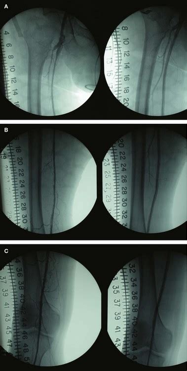 Femoral Endarterectomy Procedure