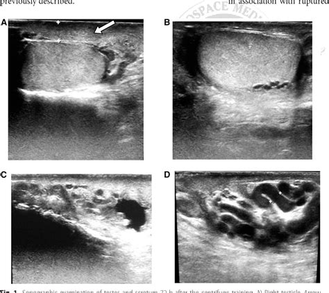 Scrotal Hematoma Precipitated by Centrifuge Training in a Fighter Pilot with an Asymptomatic ...