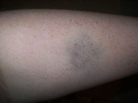 Ever Get A Bruise And Don't Know How You Did It? / myLot