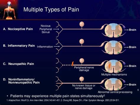 Nociceptive Pain - Arthritis Rheumatism