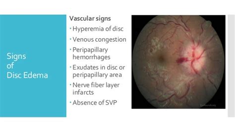 Differential Diagnosis of Disc Edema