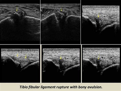 Presentation1.pptx. ultrasound examination of the ankle joint.