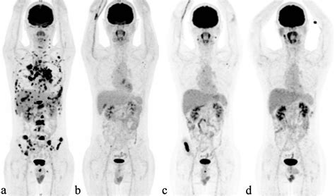 Pet Scan Images Of Lymphoma