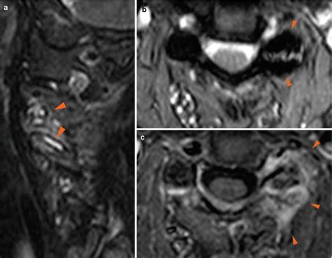 Facet Joint Arthropathy Mri