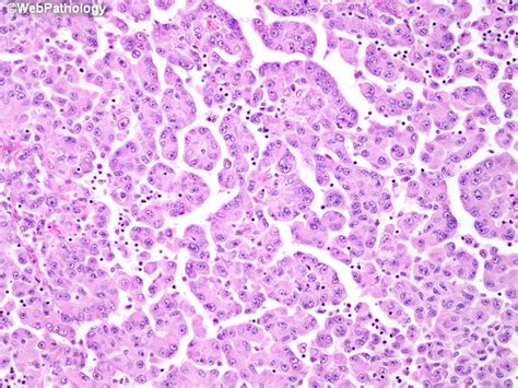 peritoneal mesothelioma histology Pathology outlines