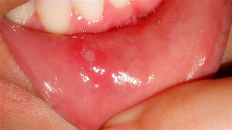 Canker Sore - Causes, Symptoms | How to Get Rid of Canker Sores ...