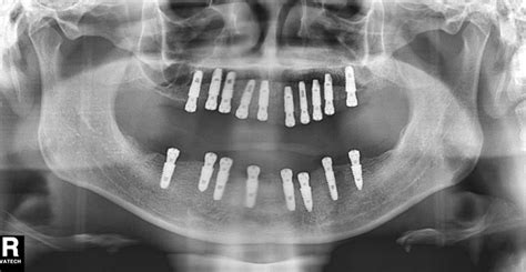 Full mouth reconstruction with Surgical Guide Technology – Hiossen ...