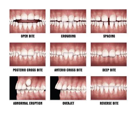 Malocclusion - Signs, Causes and Impacts - Nha Khoa Numberone