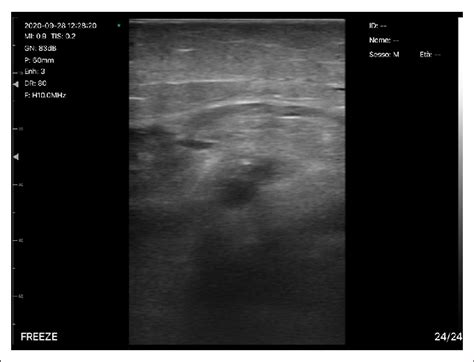 Ultrasound visualization of right superficial femoral artery and right... | Download Scientific ...