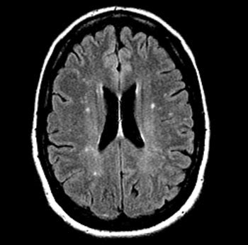 MRI Study Shows Migraines with Aura Unrelated to Brain Anomalies - MRI - MedImaging.net