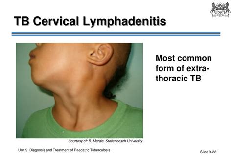 PPT - Unit 9: Diagnosis and Treatment of Paediatric Tuberculosis PowerPoint Presentation - ID:859364