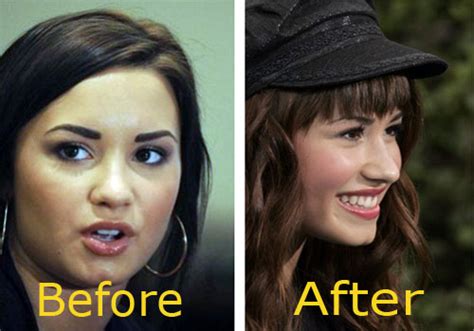 Demi Lovato Plastic Surgery Before And After Pictures