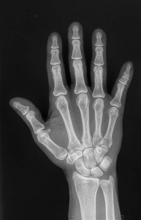 Brachydactyly type A3 | Image | Radiopaedia.org