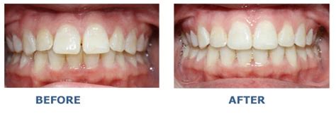 Magic of a Retainer: Before and After Photos to Prove It | New Health ...