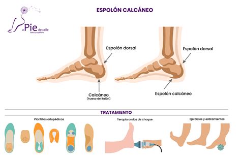 Espolon calcaneo: síntomas, consejos y tratamiento