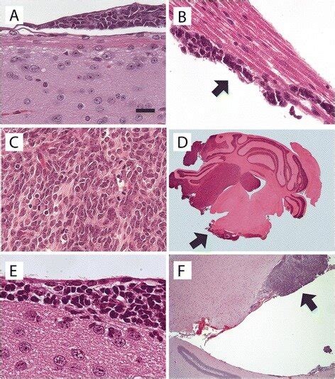 Histopathology of leptomeningeal dissemination. A, Aggregates of ...