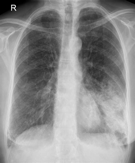 Xray pneumonia - defensehoure