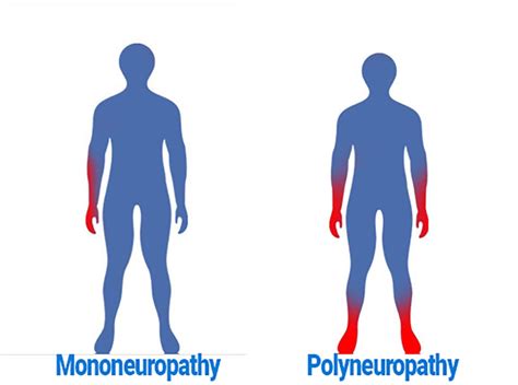 CAUSES AND TYPES POLYNEUROPATHY - Effective Physiotherapy Clinic, Abuja