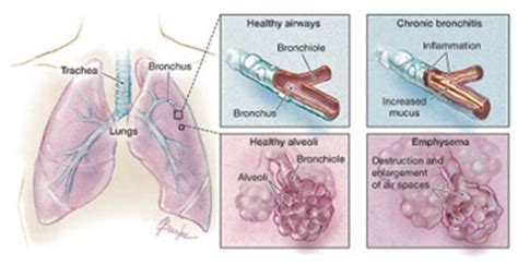 Sonidos pulmonares de Rhonchi: definición, causas y tratamiento | Estudyando