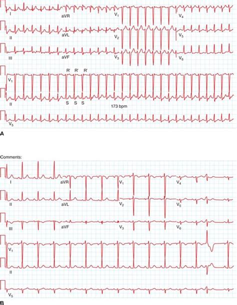 TYPICAL ATRIOVENTRICULAR NODAL REENTRANT TACHYCARDIA - Color Atlas and Synopsis of ...