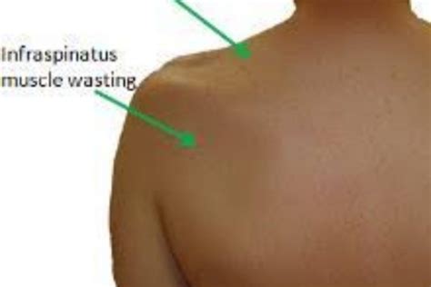 Suprascapular Nerve Entrapment | Bangalore Shoulder Institute