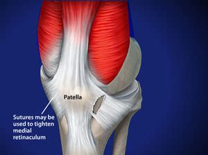 Lateral Release and Medial Imbrication by Dr. Darren Keiser MD