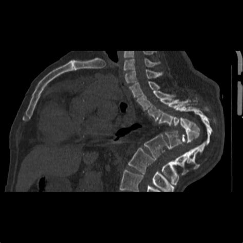 Gibbus deformity secondary to tuberculosis | Radiology, Body infection ...