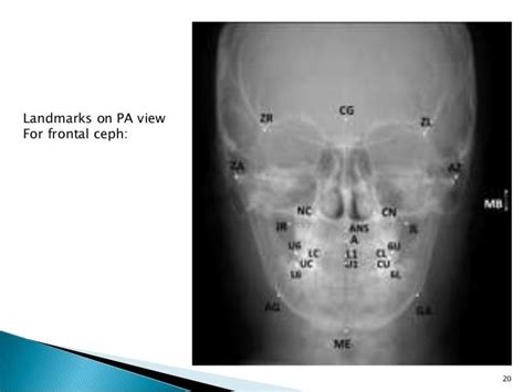 Facial asymetries