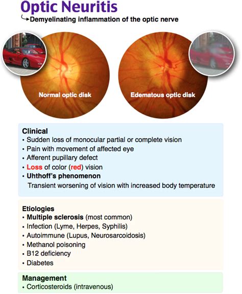 Rosh Review | Optic neuritis, Optometry education, Opthalmic technician