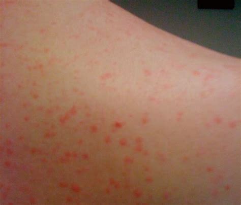 Cholinergic Urticaria - Treatment, Pictures, Symptoms, Causes