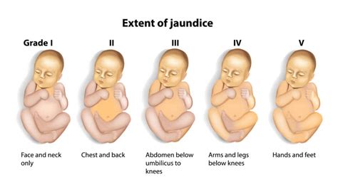 Caput Succedaneum: Causes, Treatment and More - Birth Injury Guide