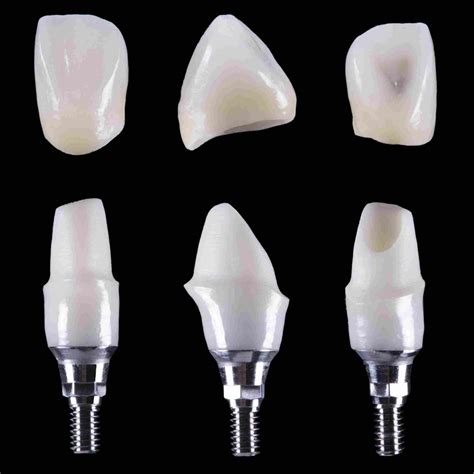 Difference Between Zirconia Crowns vs Porcelain Crowns - Kate Brayman DDS